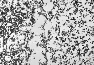 F,8y. | varicellous pneumonia F,8y. | varicellous pneumonia